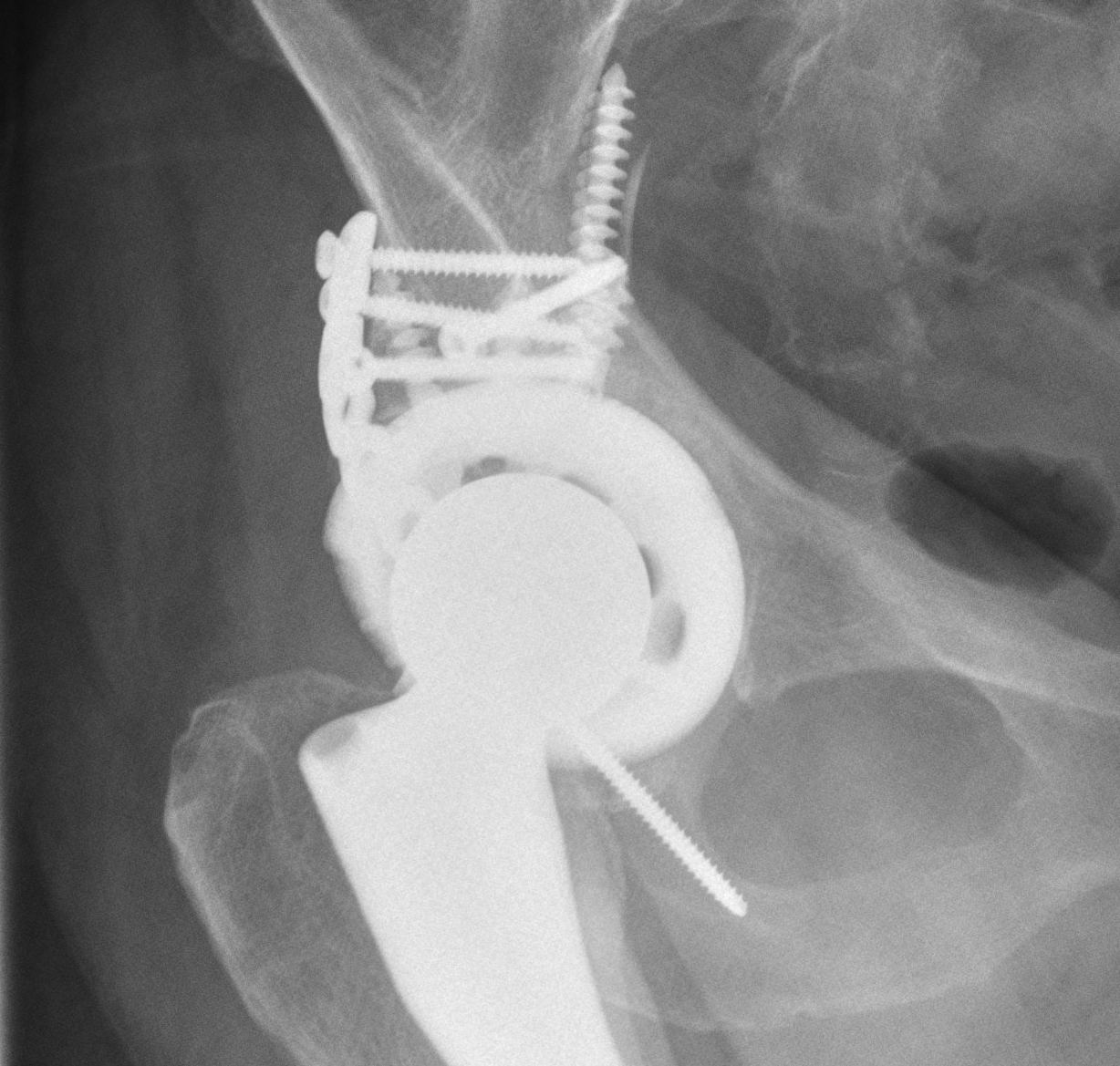 THR Fractured Acetabulum 2